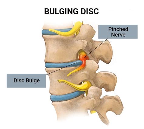 Cervical Slipped Disc/Bulging Disc Doctors NJ & NYC