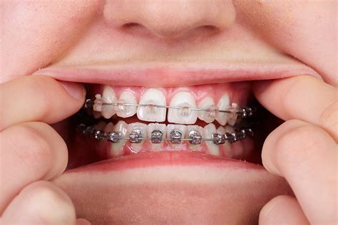 Clear Braces vs. Metal Braces.