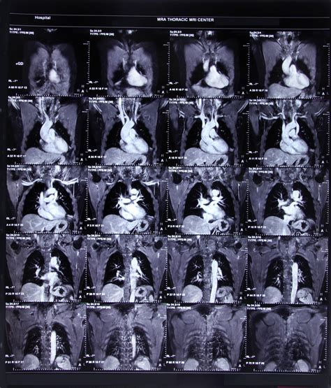 CT Pulmonary Angiography Measurements as a Predictive Tool for Pulmonary Hypertension