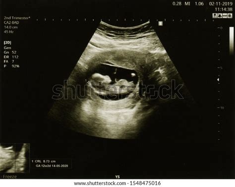 Ultrasound 3 Weeks: Over 31 Royalty-Free Licensable Stock Photos | Shutterstock