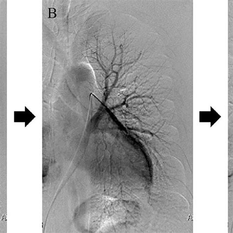 Figure5.Pulmonary angiography (PAG) images of the patient. The left... | Download Scientific Diagram