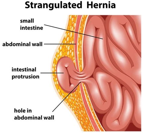 Get Specific With 12 New Hernia Repair Codes : CPT® 2023 Changes