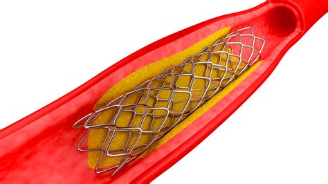 What is a stent? – Australian Heart