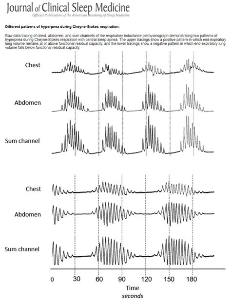 Two Distinct Patterns of Hyperpnea During Cheyne-Stokes Respiration: Implication for Cardiac ...