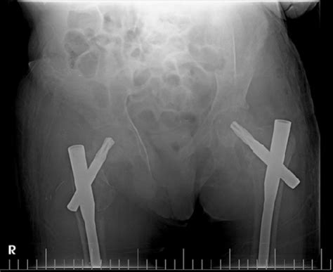 Pelvic X-ray anteroposterior (AP) view post bilateral long proximal... | Download Scientific Diagram