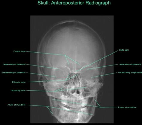 SKULL AP X RAY ANATOMY