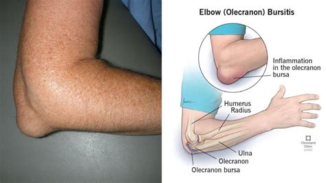 Elbow (Olecranon) Bursitis: Symptoms, Causes Treatment, 46% OFF