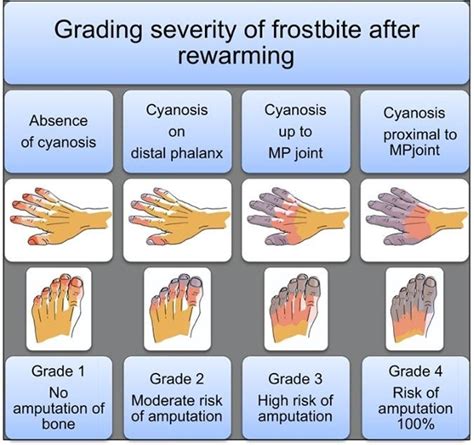 TPA in Frostbite — NUEM Blog