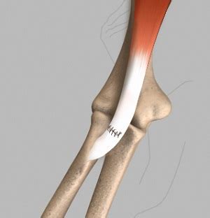 Distal Biceps Tendon Surgery