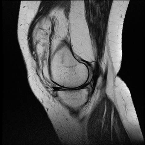 Rheumatoid arthritis MRI - wikidoc