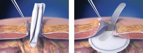 UMBILICAL VENTRAL HERNIA | Hernia Surgery in Dubai