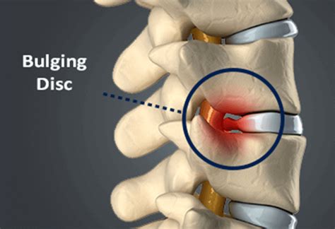 Bulging Disc - Causes, Symptoms & Treatment | Bonati Spine Institute