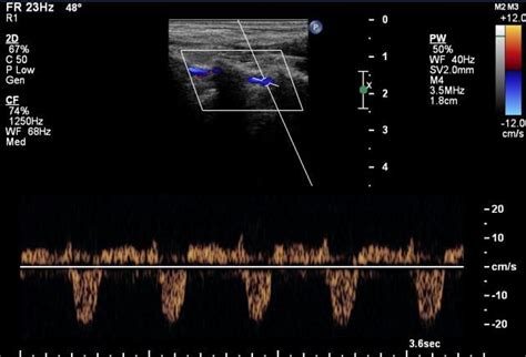 Subclavian steal syndrome - on ultrasound | Radiology Case | Radiopaedia.org case study ...