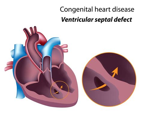 What Is a Heart Murmur? It May Be Harmless—or It May Indicate Heart Valve Problems