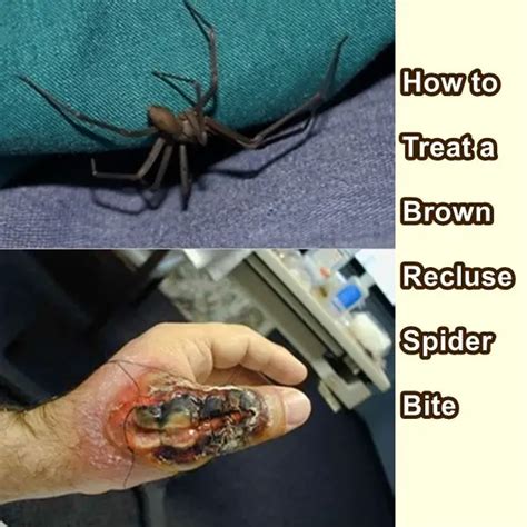 Brown Recluse Spider Bite Rash