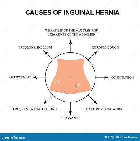 Inguinal Hernia Cartoon Vector | CartoonDealer.com #25447441