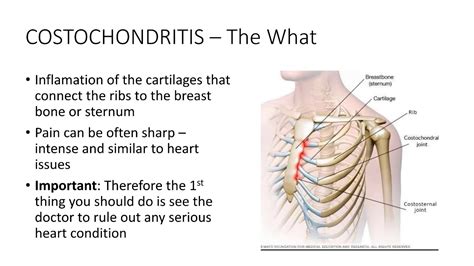 Healthool Costochondral Separation Symptoms Diagnosis