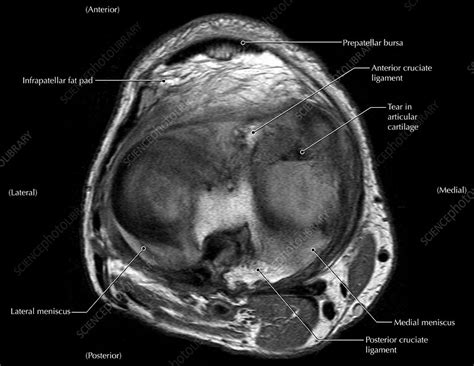 Knee Arthritis, MRI - Stock Image - C027/1211 - Science Photo Library