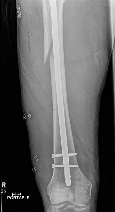 [UPDATE] Post-Op X-Rays of my femoral nail. (An acorn caused my wheel to flip sideways while ...