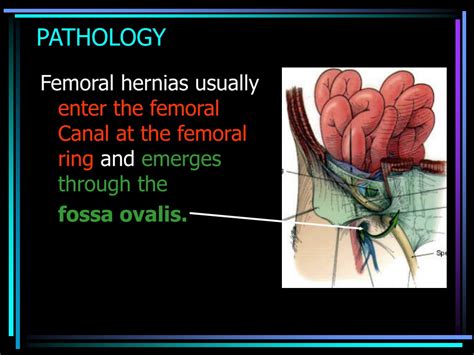 Femoral Hernia