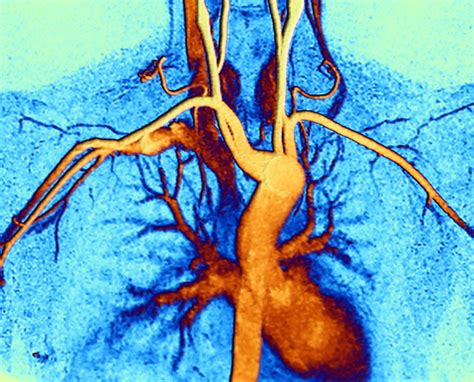 Digital Subtraction Pulmonary Angiography in Children With PH Due to BPD - Pulmonology Advisor