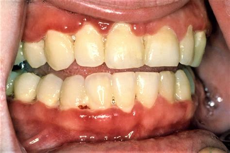 Trench mouth disease causes, symptoms, diagnosis, treatment & prognosis