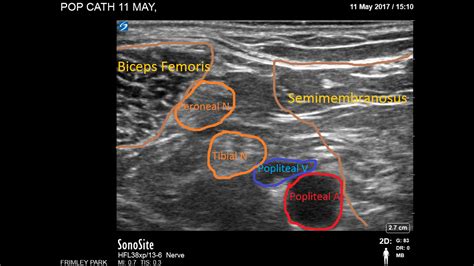 Popliteal Sciatic Block