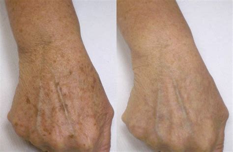 Age Spot Treatment and Age Spot Removal