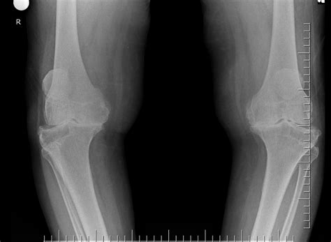 Knee extensor power is related to mobility in osteoarthritis.