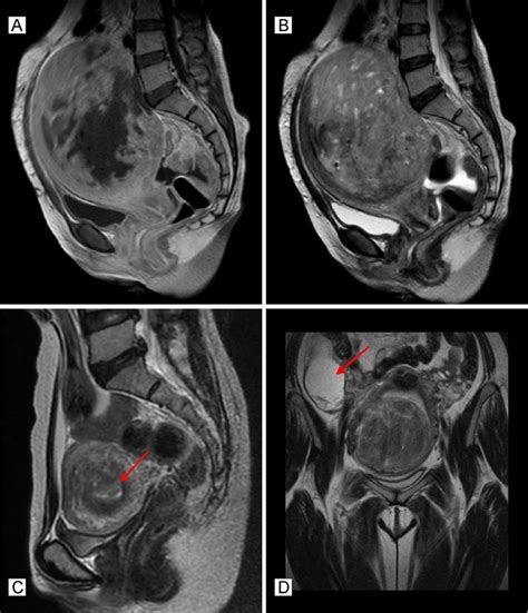 Large Fibroid Uterus Surgery