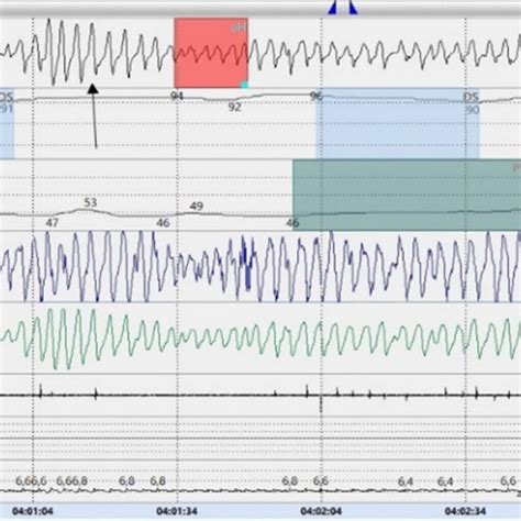 (PDF) First Description of the Hyperpnea–Hypopnea Periodic Breathing in Patients with ...