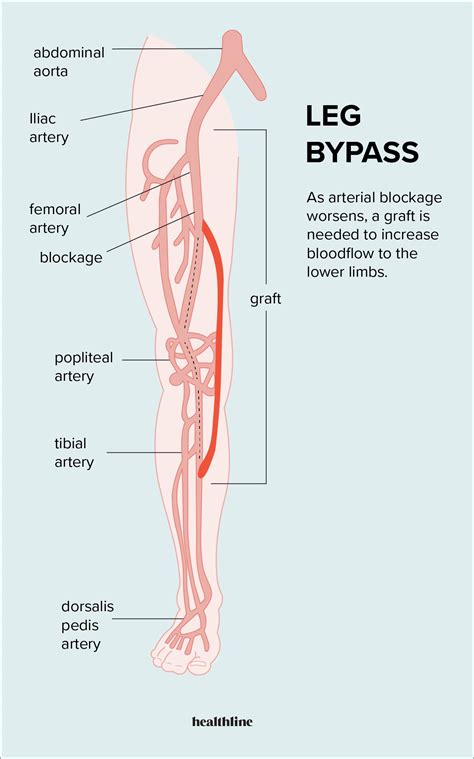 Leg Bypass Surgery: Everything You Need To Know