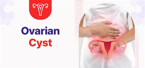 Ovarian Cyst: Diagnoses, Costs And Treatment In Gurgaon - Gmoney.in