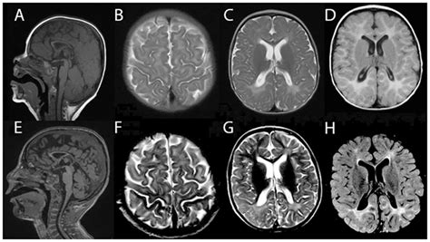 Brain MRI demonstrated white matter abnormality suggesting... | Download Scientific Diagram