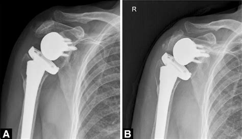 Acromial Fracture