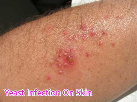 skin yeast infection - pictures, photos