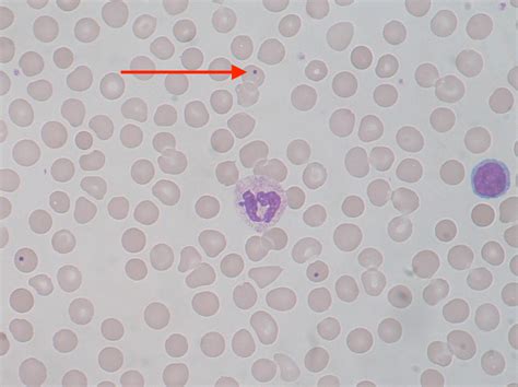 Sickle Cell Anemia - USMLE Strike