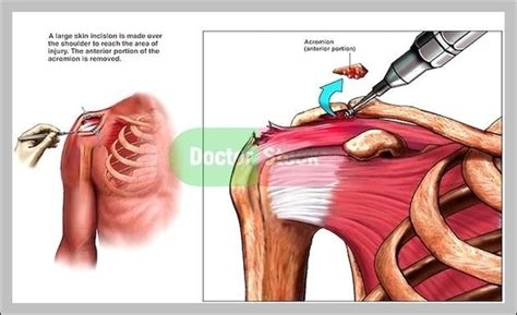 Acromion Bone Image | Anatomy System - Human Body Anatomy diagram and chart images