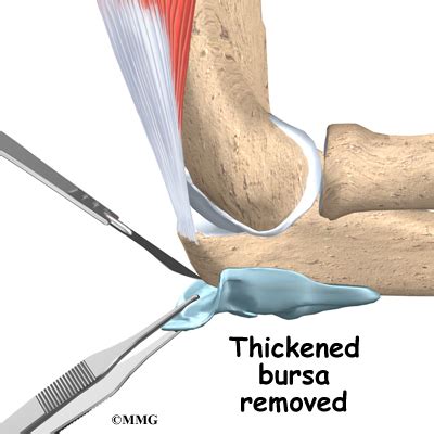 Olecranon Bursitis | eOrthopod.com