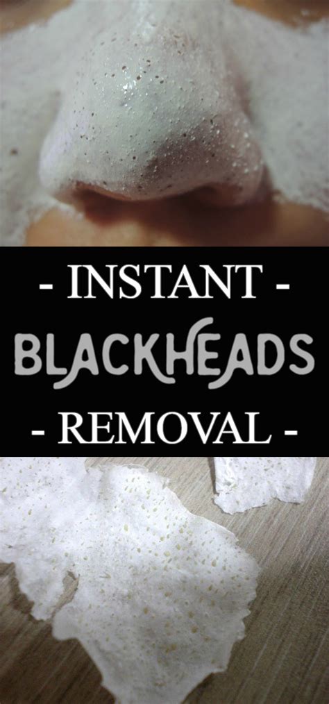 Instant blackheads removal | HEALTHYLIFE