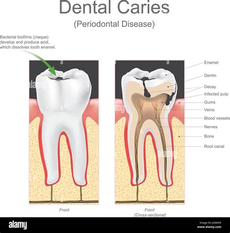 Tooth Decay Diagram