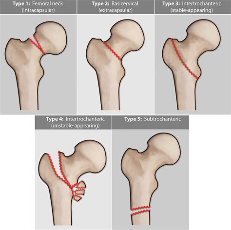 Left femoral neck fracture - maleAslo