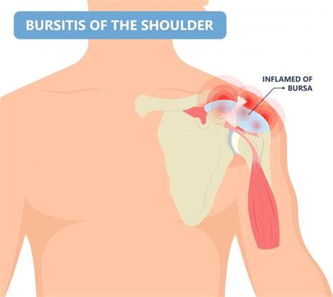 Mri Shoulder Bursitis