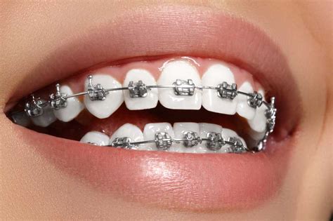 Braces - Level Orthodontics