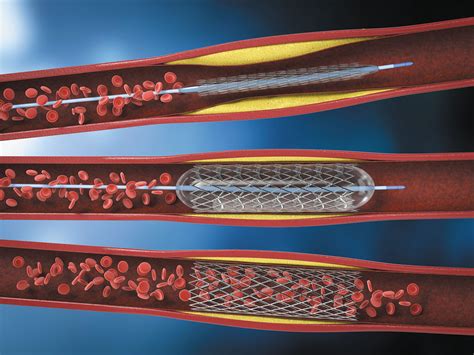 The story on heart stents - Harvard Health