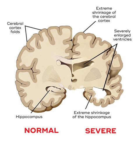 What causes dementia? - Queensland Brain Institute - University of Queensland