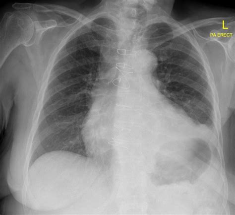 Diaphragmatic paralysis x ray - wikidoc