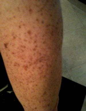 Brown Spots on Legs – Causes, How to Get Rid of Dark Spots, Remove Small, Scaly Raised Sun, Age ...