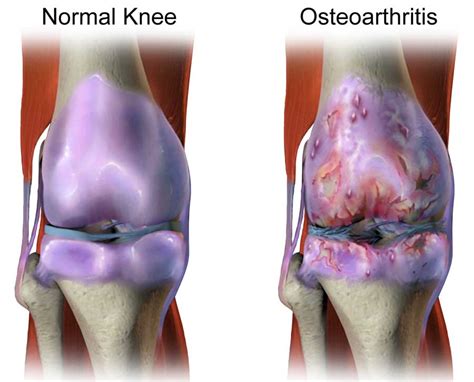 Knee Osteoarthritis - Diagnosis, Treatment & Therapy | Dr. Scott Naftulin