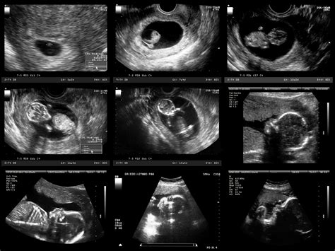 When Is The Baby Visible On A Ultrasound - Baby Viewer